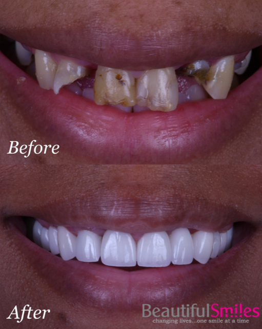 Beautiful Smiles | Laser Dentistry, Dental Fillings and Dental Bridges