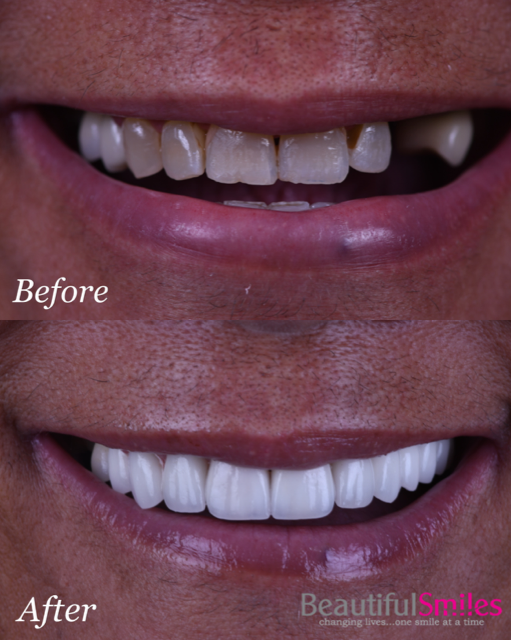 Beautiful Smiles | Implant Dentistry, Night Guards and Preventative Program