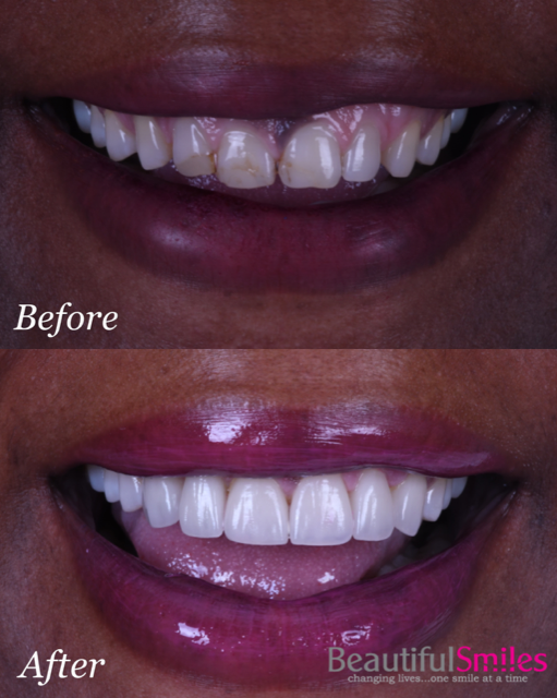 Beautiful Smiles | Pediatric Dentistry, CEREC reg  Crowns and Invisalign reg 