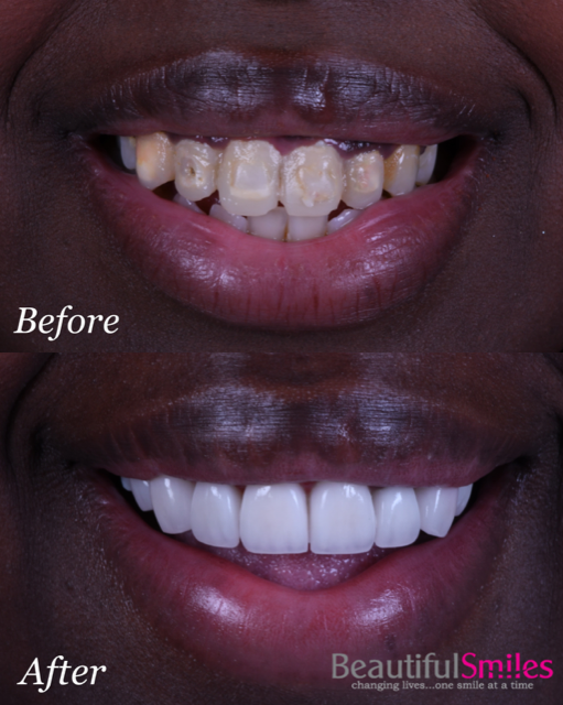 Beautiful Smiles | Botox reg , CEREC reg  Crowns and Invisalign reg 