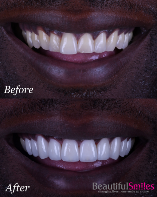 Beautiful Smiles | Root Canals, Invisalign reg  and Dental Bridges