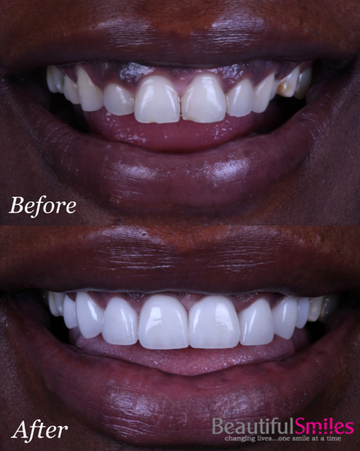 Beautiful Smiles | Dental Bridges, Root Canals and Dentures